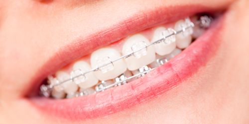 Braces in Mount Pearl