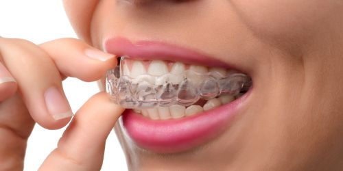 Invisalign in Mount Pearl
